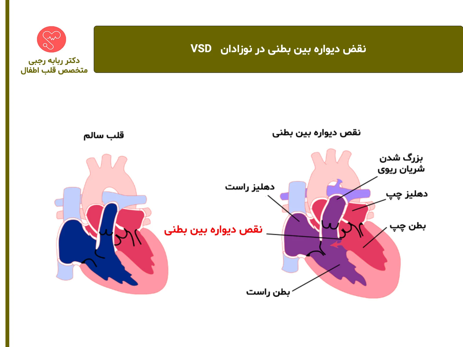 سوراخ سپتوم بین بطنی در کودکان (VSD)