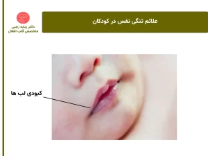 کبودی-لبها-علائم-بیماری-قلبی