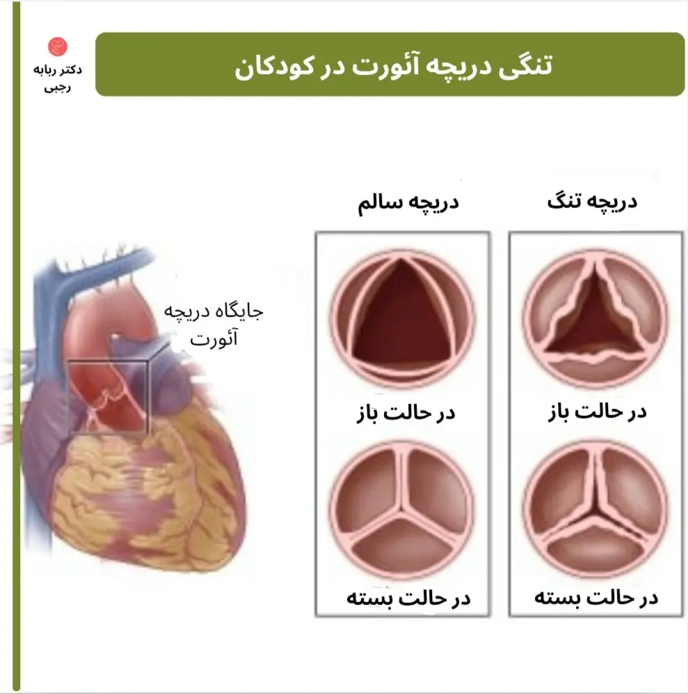 تصویر تنگی دریچه آئورت در کودکان 
