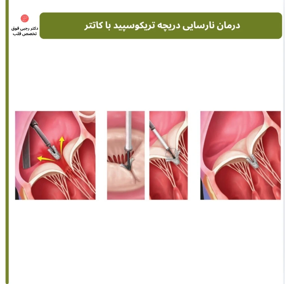 درمان ترمیمی نارسایی دریچه سه لایه در نوزادان